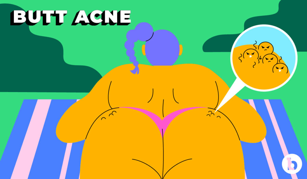 Dermatologist Dr. Karan Lal examines the causes of butt acne and shares tips on treatment and pimple prevention