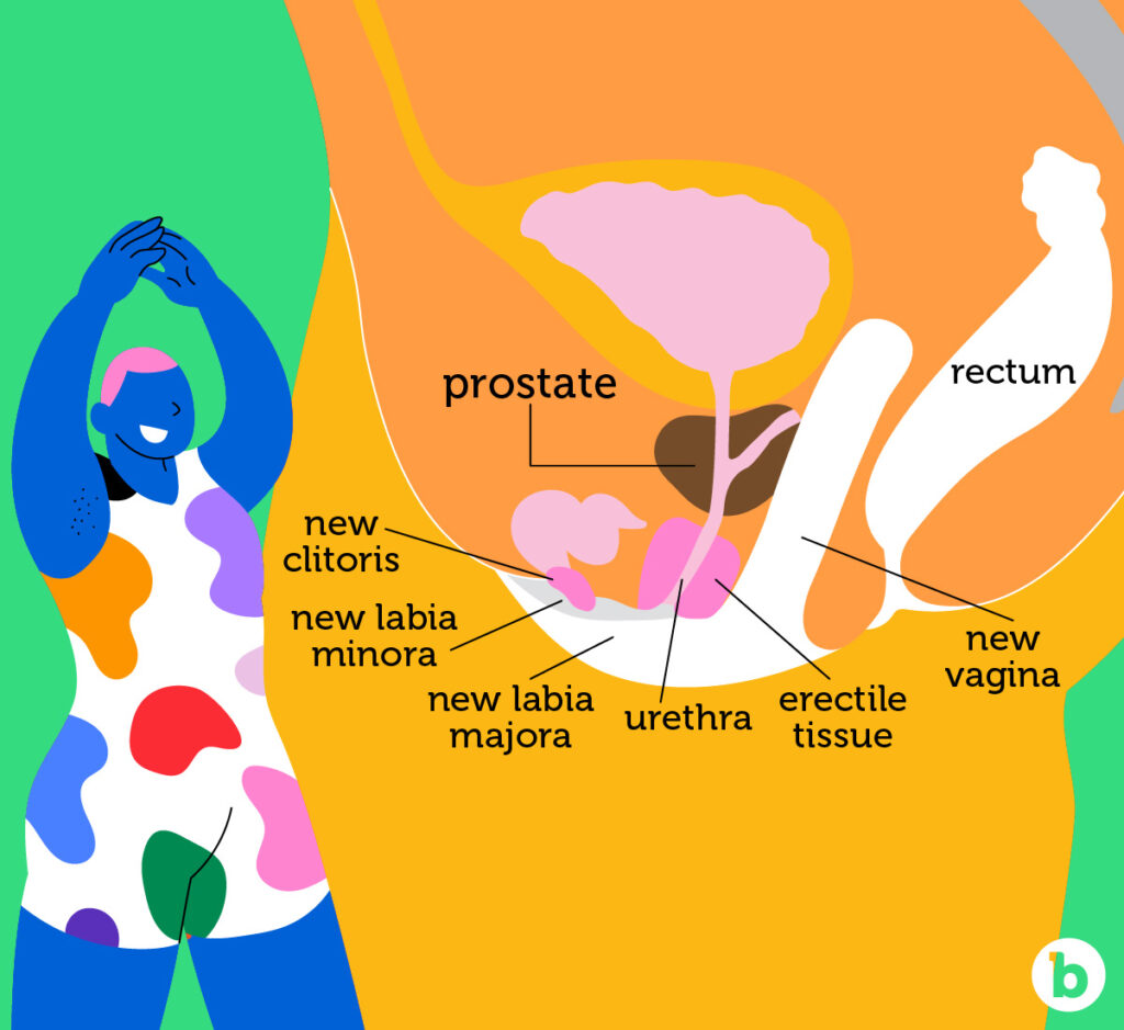 Prostate Anatomy of Trans Women Post-Op
